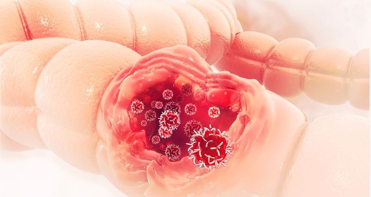 Kenali Sejak Awal, Gejala Kanker Kolorektal Sering Tak Disadari