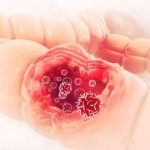 Kenali Sejak Awal, Gejala Kanker Kolorektal Sering Tak Disadari