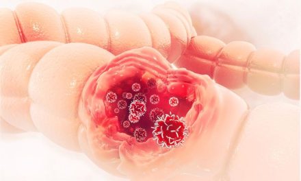 Kenali Sejak Awal, Gejala Kanker Kolorektal Sering Tak Disadari